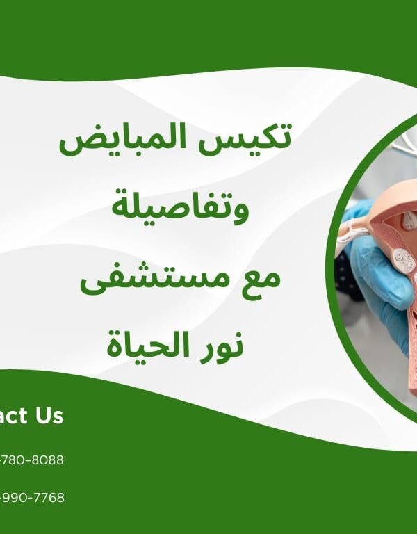 تكيس المبايض وتفاصيله